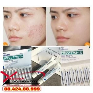 Kem Mụn Dalacin T Gel 1% 10g