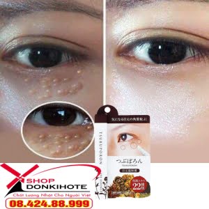 Xóa tan ám ảnh mụn thịt quanh mắt chỉ sau 1-2 ngày