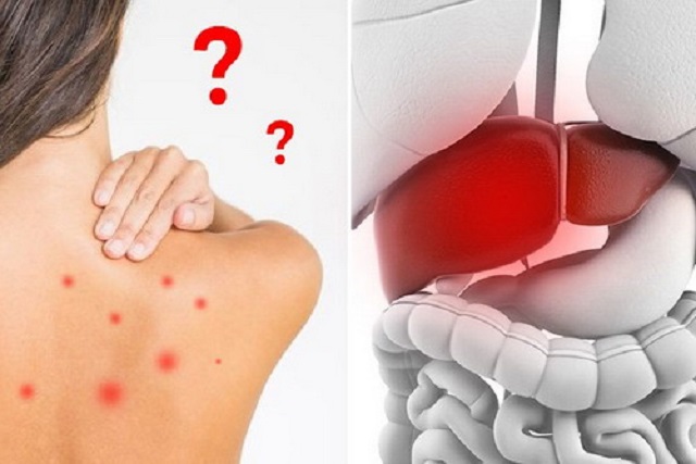 Lý do cần sử dụng uống thuốc bổ gan để trị mụn