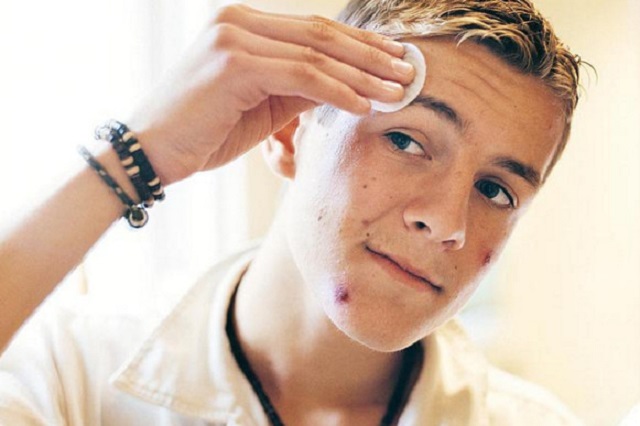 Lạm dụng mỹ phẩm khiến cho tình trạng mụn ngày càng tệ