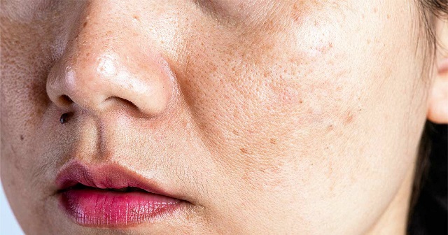 Nám khiến chị em thiếu tự tin khi giao tiếp