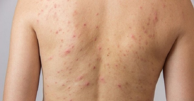 Xà phòng trị mụn lưng của Nhật